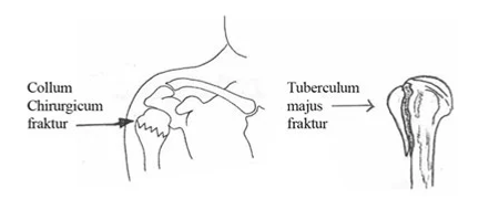 Överarm med en fraktur