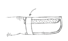 Fingertopp från sidan med skena på ovansidan av fingertoppen. Tejp som applicerats på mittendelen av fingret och runt skenan på ovansidan. oc